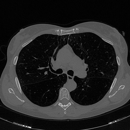 Imagen Cáncer de pulmón